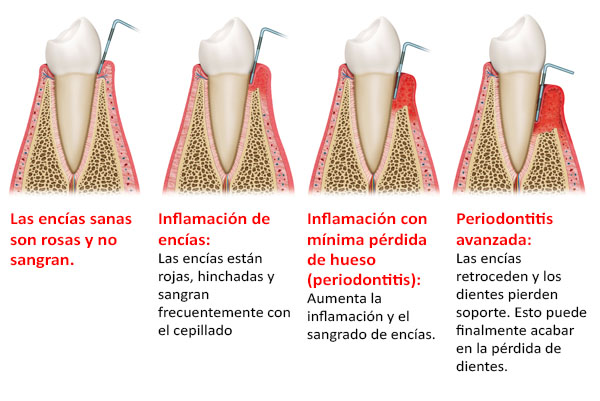 El Sangrado de encías puede terminar el la perdida de dientes