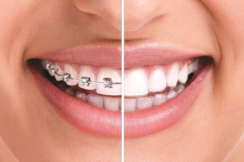 BRACKETS O INVISALING